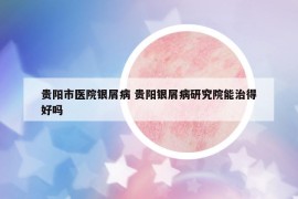 贵阳市医院银屑病 贵阳银屑病研究院能治得好吗