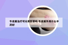 牛皮廨治疗可以用野草吗 牛皮廨外用什么中药好