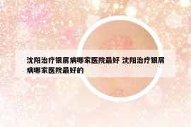 沈阳治疗银屑病哪家医院最好 沈阳治疗银屑病哪家医院最好的