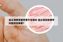 连云港哪家医院看牛皮癣好 连云港皮肤病专科医院在哪里?