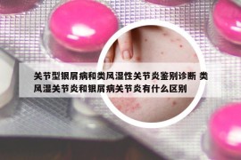 关节型银屑病和类风湿性关节炎鉴别诊断 类风湿关节炎和银屑病关节炎有什么区别
