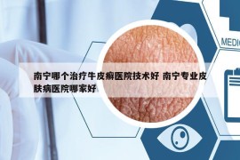 南宁哪个治疗牛皮癣医院技术好 南宁专业皮肤病医院哪家好