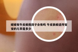 姥姥有牛皮癣我孩子会有吗 牛皮肤癣遗传宝宝的几率是多少