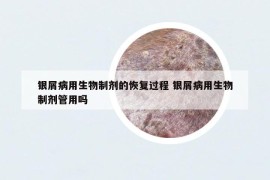 银屑病用生物制剂的恢复过程 银屑病用生物制剂管用吗
