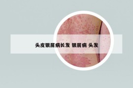 头皮银屑病长发 银屑病 头发