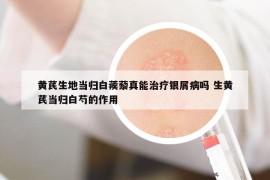 黄芪生地当归白蒺藜真能治疗银屑病吗 生黄芪当归白芍的作用