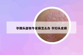 孕期头部有牛皮癣怎么办 孕妇头皮癣
