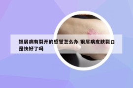 银屑病有裂开的感觉怎么办 银屑病皮肤裂口是快好了吗