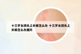 十三岁女孩头上长癣怎么办 十三岁女孩头上长癣怎么办图片