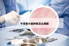 牛皮癣小腿肿胀怎么缓解