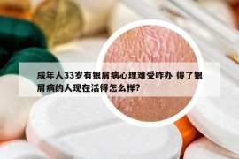 成年人33岁有银屑病心理难受咋办 得了银屑病的人现在活得怎么样?