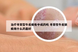 治疗寻常型牛皮癣有中成药吗 寻常性牛皮肤癣用什么药最好