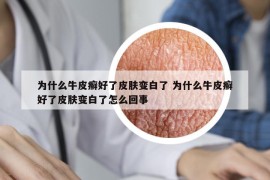 为什么牛皮癣好了皮肤变白了 为什么牛皮癣好了皮肤变白了怎么回事