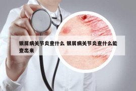 银屑病关节炎查什么 银屑病关节炎查什么能查出来