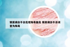 银屑病会不会出现梅毒偏高 银屑病会不会误查为梅毒