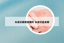 头皮红癣症状图片 头皮红色皮癣