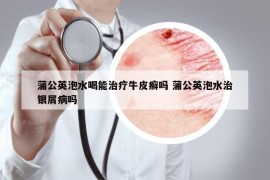 蒲公英泡水喝能治疗牛皮癣吗 蒲公英泡水治银屑病吗