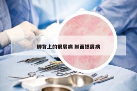 脚背上的银屑病 脚面银屑病