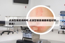 点滴型银屑病痒吗 点滴型银屑病瘙痒是好转前兆!