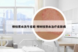 柳枝煮水洗牛皮癣 柳树枝熬水治疗皮肤病