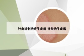 针灸挑刺治疗牛皮癣 针灸治牛皮廨