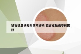 延吉银屑病专科医院好吗 延吉皮肤病专科医院