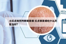 小红点如何判断银屑病 红点银屑病吃什么药能治好?