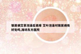银屑病艾草泡澡后更痒 艾叶泡澡对银屑病有好处吗,潍坊东方医院