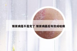 银屑病是不是完了 银屑病最后导致成啥病