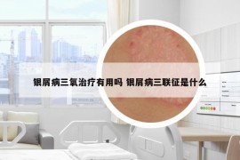 银屑病三氧治疗有用吗 银屑病三联征是什么