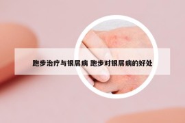 跑步治疗与银屑病 跑步对银屑病的好处