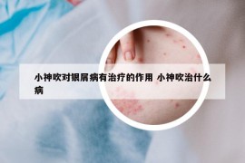 小神吹对银屑病有治疗的作用 小神吹治什么病