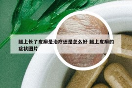 腿上长了皮癣是治疗还是怎么好 腿上皮癣的症状图片