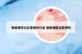 银屑病可以从事餐饮行业 银屑病能当厨师吗