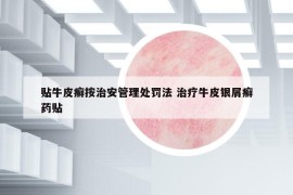 贴牛皮癣按治安管理处罚法 治疗牛皮银屑癣药贴