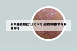 副银屑病用达力士可以吗 副银屑病抹药后会变白吗