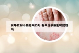 有牛皮癣小孩能喝奶吗 有牛皮病癣能喝奶粉吗