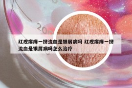 红疙瘩痒一挤流血是银屑病吗 红疙瘩痒一挤流血是银屑病吗怎么治疗