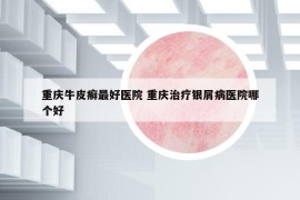 重庆牛皮癣最好医院 重庆治疗银屑病医院哪个好