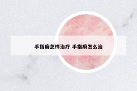 手指癣怎样治疗 手指癣怎么治