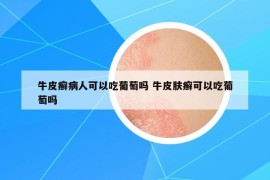 牛皮癣病人可以吃葡萄吗 牛皮肤癣可以吃葡萄吗