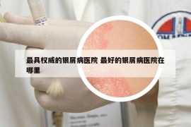 最具权威的银屑病医院 最好的银屑病医院在哪里