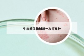 牛皮癣生物制剂一次打几针