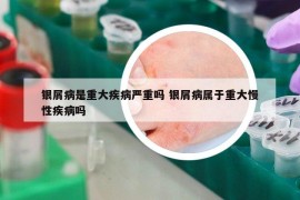 银屑病是重大疾病严重吗 银屑病属于重大慢性疾病吗