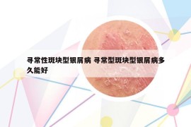 寻常性斑块型银屑病 寻常型斑块型银屑病多久能好