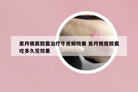 紫丹银屑胶囊治疗牛皮癣效果 紫丹银屑胶囊吃多久见效果