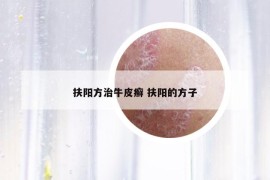 扶阳方治牛皮癣 扶阳的方子