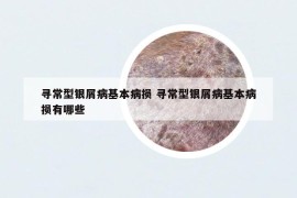 寻常型银屑病基本病损 寻常型银屑病基本病损有哪些