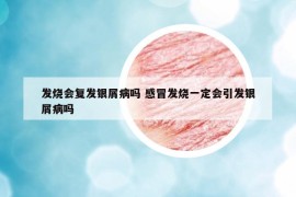 发烧会复发银屑病吗 感冒发烧一定会引发银屑病吗