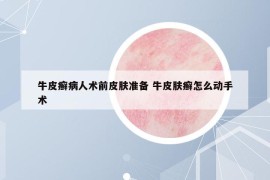 牛皮癣病人术前皮肤准备 牛皮肤癣怎么动手术
